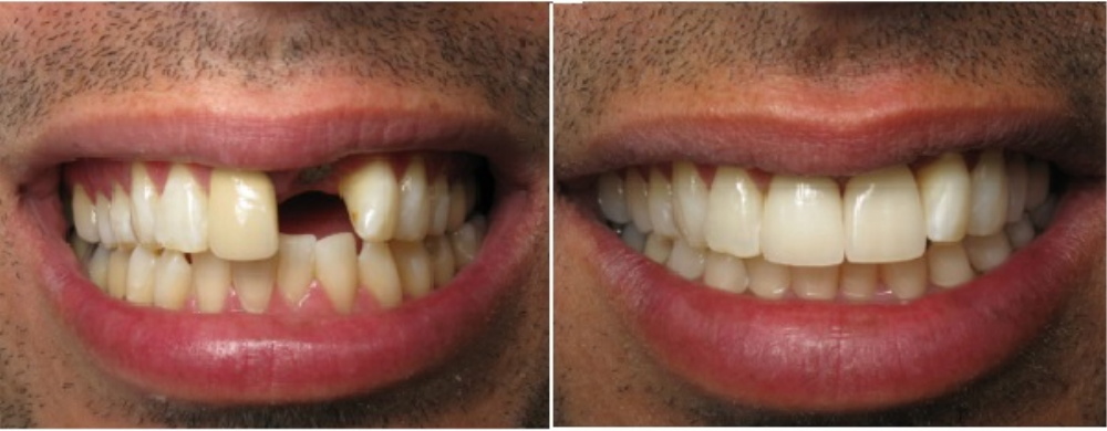 dental-bridges-before-and-after-pictures-in-kinston-nc