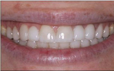 Dental Bridges Before and After Pictures Kinston, NC