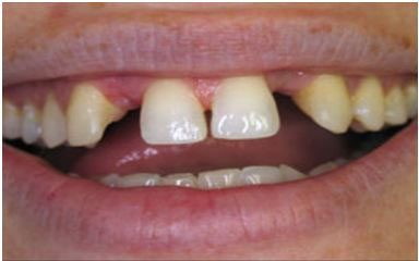 Dental Bridges Before and After Pictures Kinston, NC