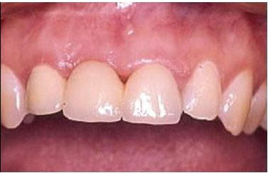 Dental Bridges Before and After Pictures Kinston, NC