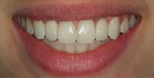 Dental Bridges Before and After Pictures Kinston, NC