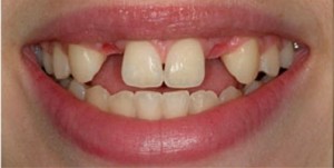 Dental Bridges Before and After Pictures Kinston, NC