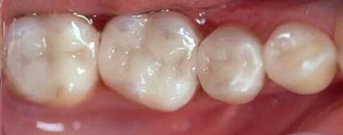 Dental Crowns Before and After Pictures Kinston, NC