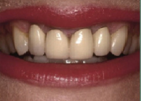 Dental Crowns Before and After Pictures Kinston, NC