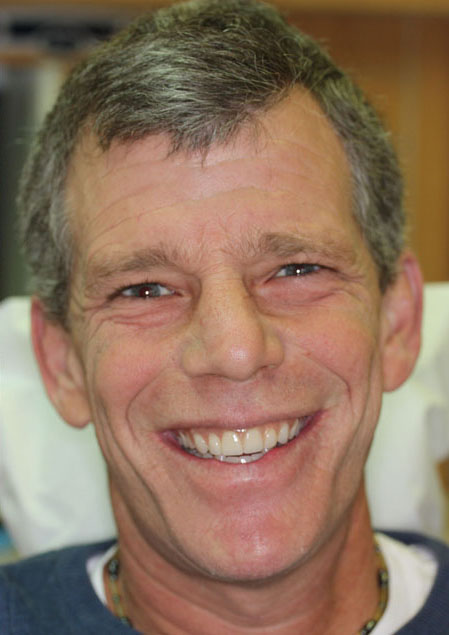Dentures Before and After Pictures Kinston, NC