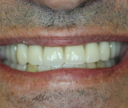 Dentures Before and After Pictures Kinston, NC