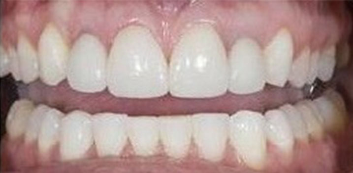 Dental Implants Before and After Pictures Kinston, NC