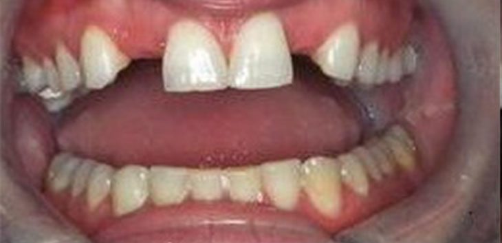 Dental Implants Before and After Pictures Kinston, NC