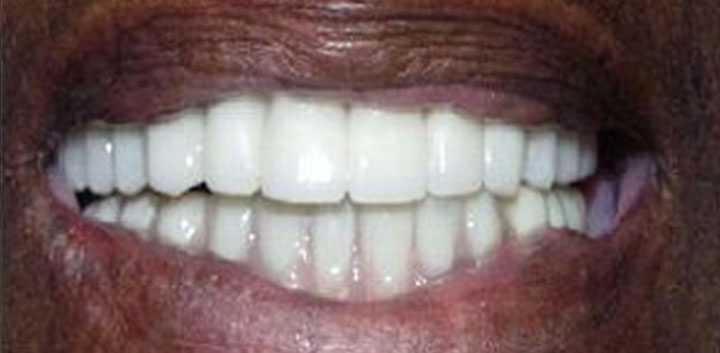 Dental Implants Before and After Pictures Kinston, NC