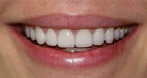 Porcelain Veneers Before and After Pictures Kinston, NC
