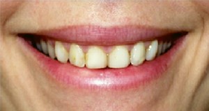 Porcelain Veneers Before and After Pictures Kinston, NC