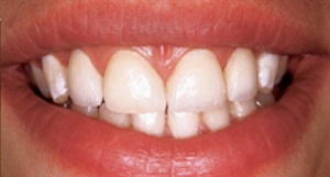 Porcelain Veneers Before and After Pictures Kinston, NC