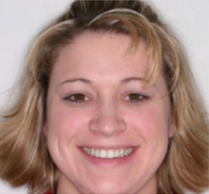 Invisalign Before and After Pictures Kinston, NC