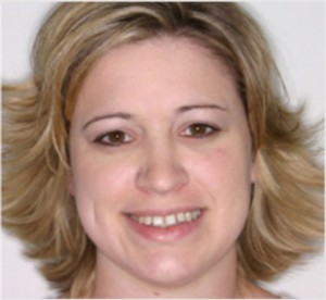 Invisalign Before and After Pictures Kinston, NC
