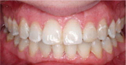 Invisalign Before and After Pictures Kinston, NC