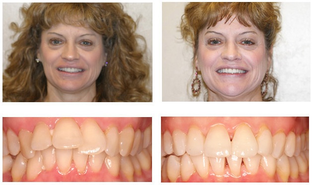 Исправление зубов брекетами фото до и после
