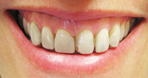 Porcelain Veneers Before and After Pictures Kinston, NC