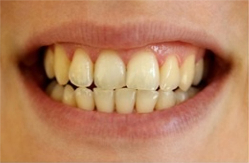 Teeth Whitening Before and After Pictures Kinston, NC