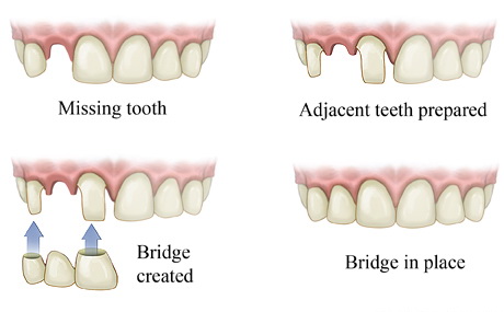 Dental Bridges Kinston Nc Dental Bridges Greenville Nc