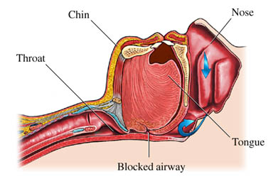 Sleep Apnea Redlands CA, Dr. Punjabi, Snoring, disrupted sleep, Loma  Linda CA