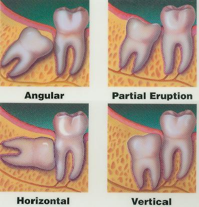 impacted wisdom tooth extraction