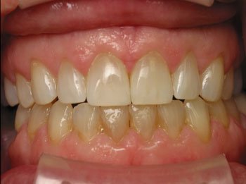 Invisalign Before and After Pictures Kinston, NC