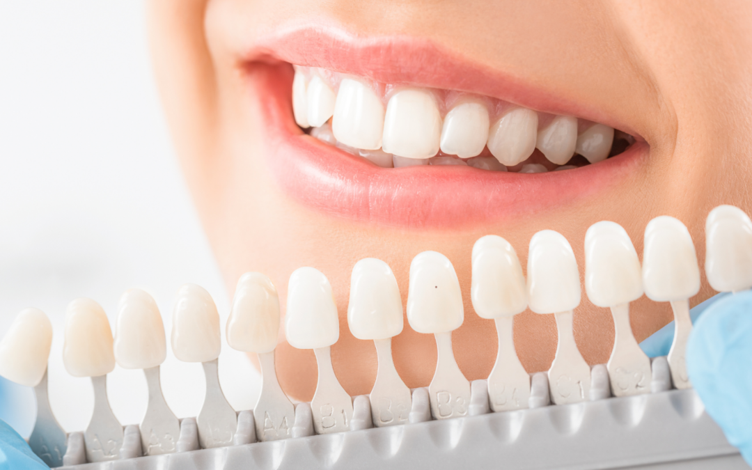 Invest In Your Smile: The Benefits Of Porcelain Veneers
