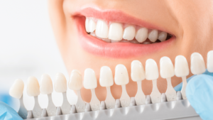 Benefits Of Porcelain Veneers