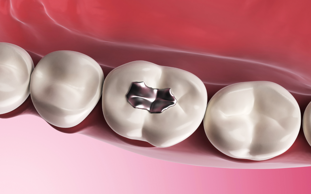 What You Need to Know About Tooth-Colored Fillings