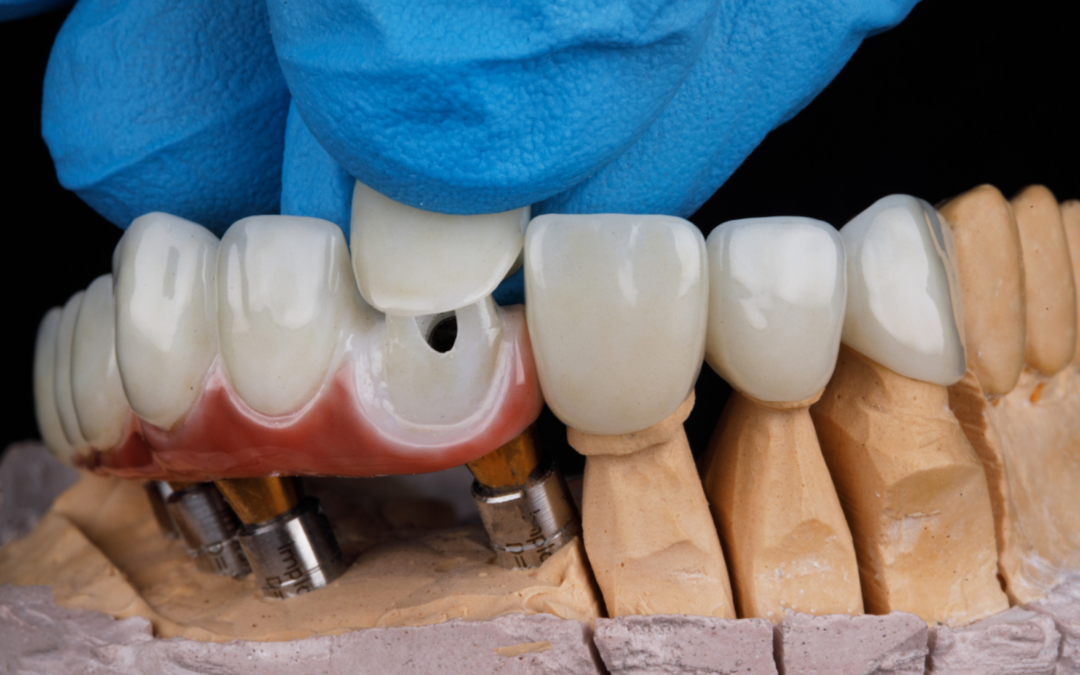 Do Porcelain Veneers Protect Your Teeth? A Comprehensive Guide