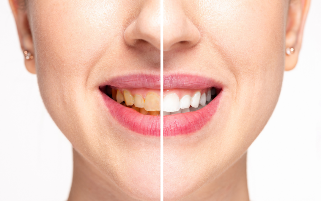 Dental Bonding Before And After