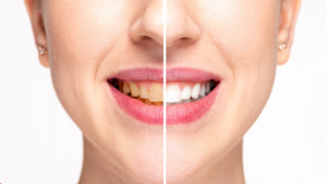 Dental Bonding Before And After