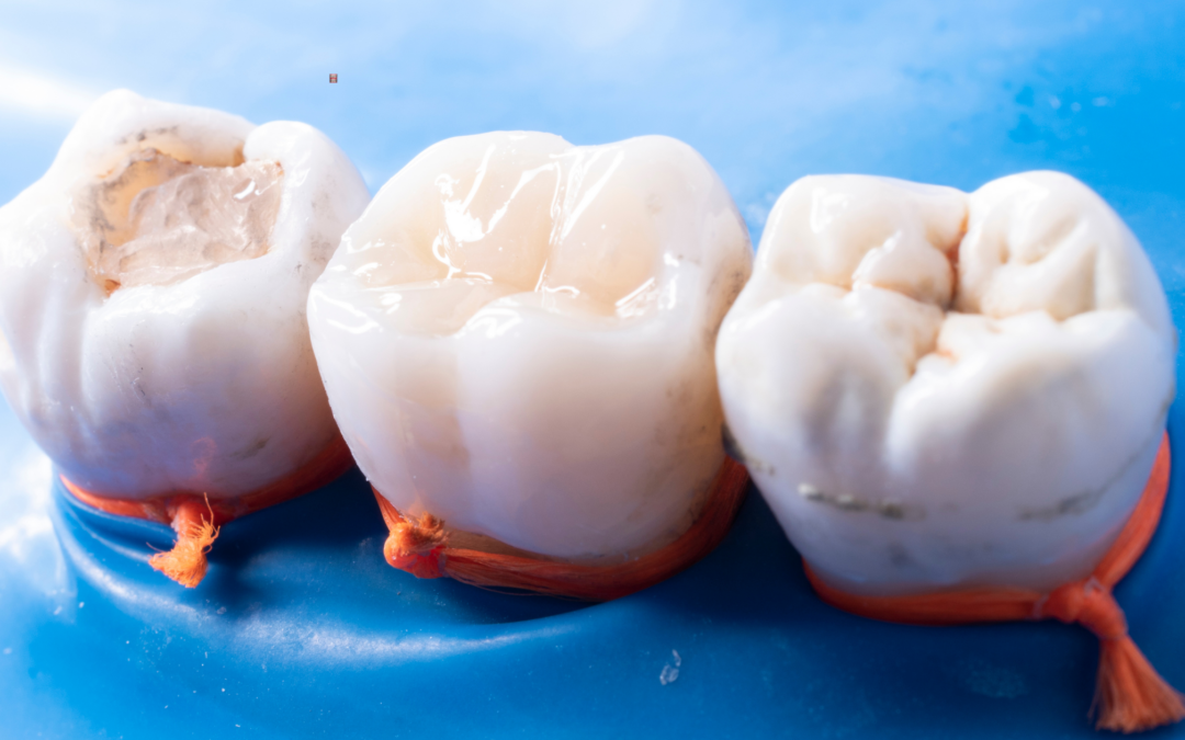 Tooth-Colored Fillings