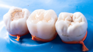 Tooth-Colored Fillings