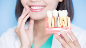 Dental implants in Greenville